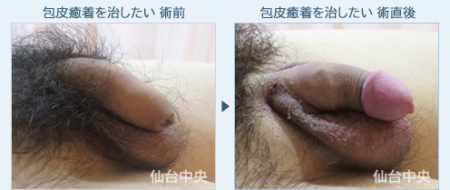 包皮癒着を治したい　症例写真2