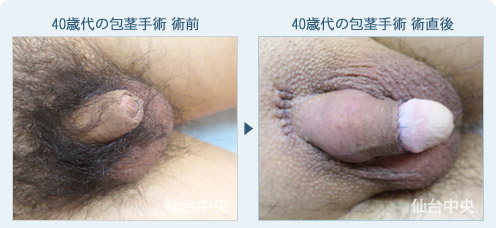 40歳代の包茎手術