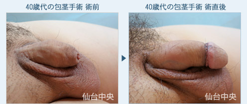 40歳代の包茎手術