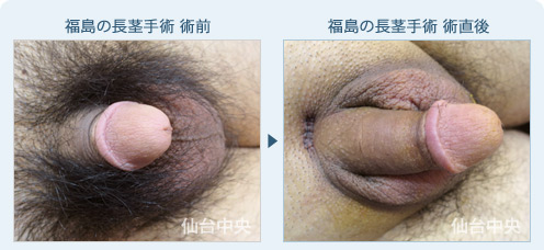 福島の長茎手術　症例写真1