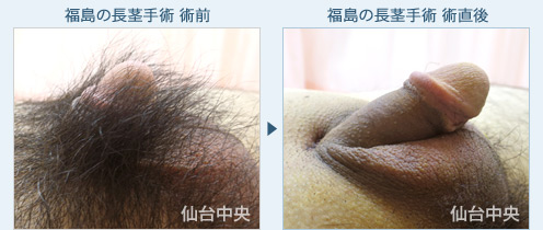 福島の長茎手術　症例写真2