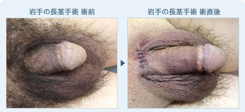 岩手の長茎手術　症例写真1