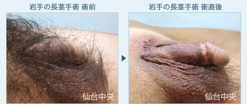 岩手の長茎手術　症例写真2