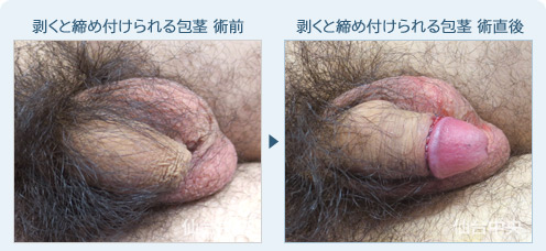 剥くと締め付けられる包茎　症例写真1