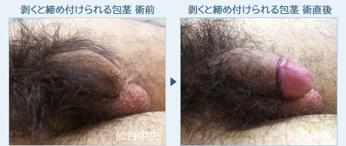剥くと締め付けられる包茎　症例写真2