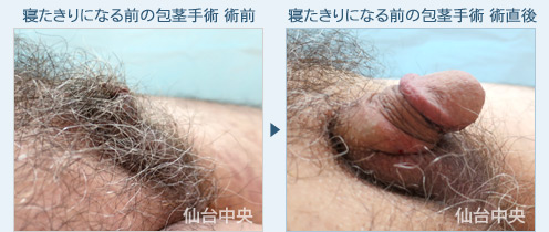 寝たきりになる前の包茎手術　症例写真2